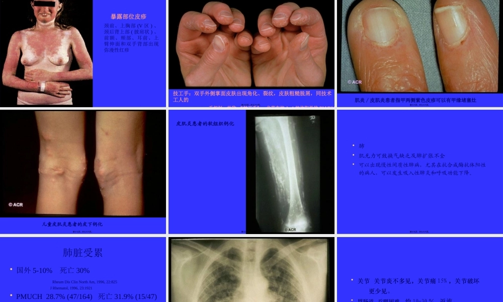 多发性肌炎&皮肌炎.pptx