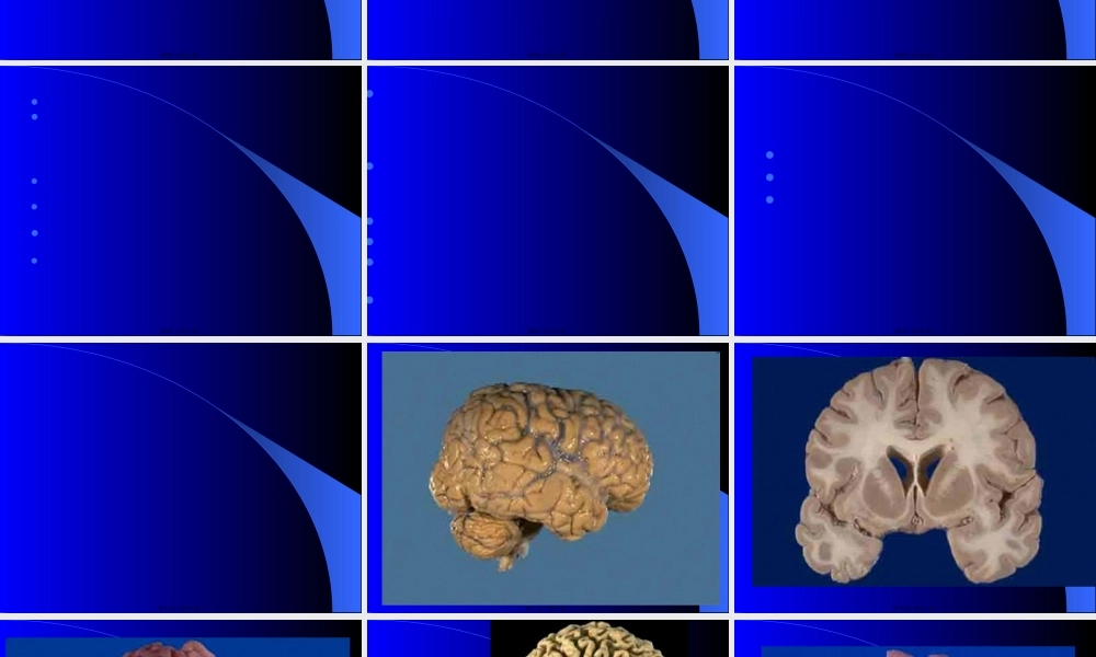 头痛Alzheimer.pptx