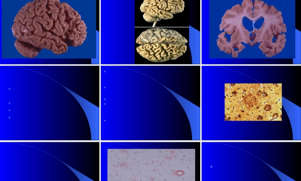 头痛Alzheimer.pptx