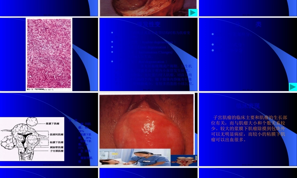 子宫肌瘤.pptx
