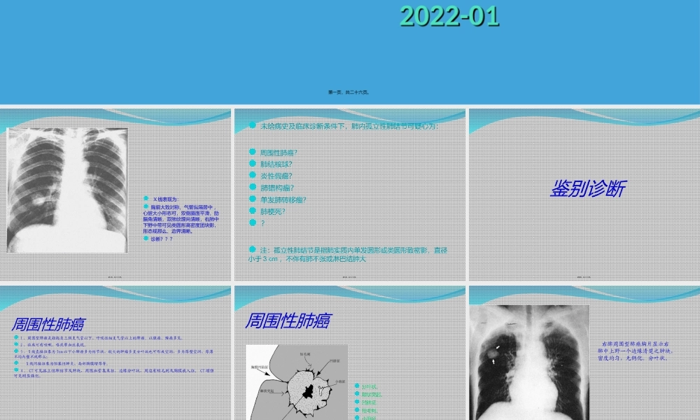 孤立性肺结节.ppt