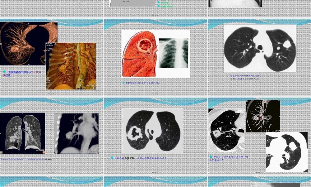 孤立性肺结节.ppt