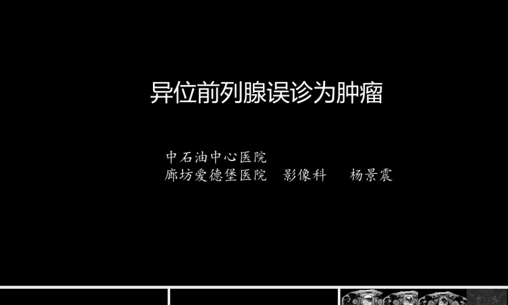 异位前列腺误诊为肿瘤(1).pptx