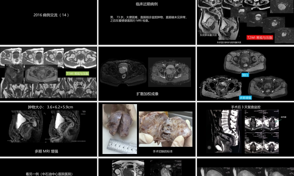 异位前列腺误诊为肿瘤(1).pptx