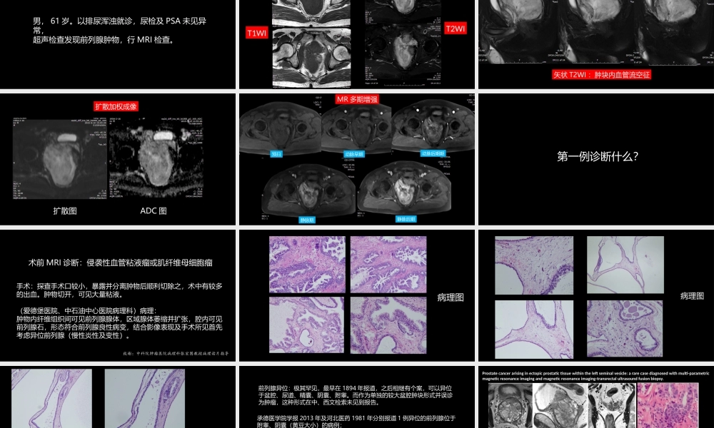 异位前列腺误诊为肿瘤(1).pptx