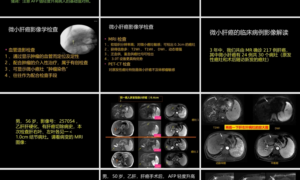 微小肝癌-MR诊断(1).ppt