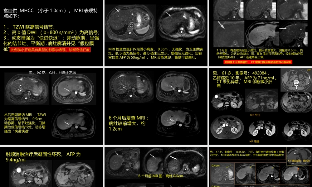 微小肝癌-MR诊断(1).ppt