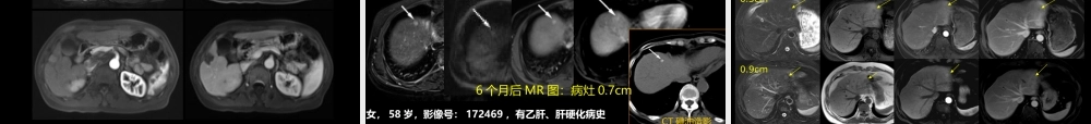 微小肝癌-MR诊断(1).ppt