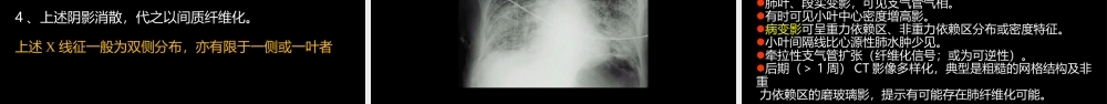 急性呼吸窘迫综合征(ARDS)的-影像学表现(1).ppt