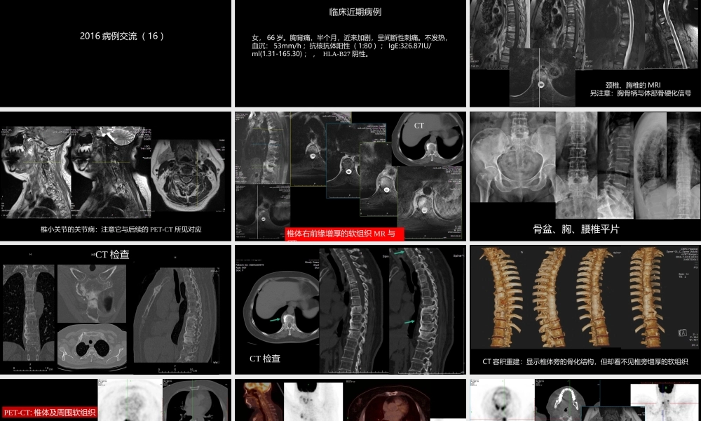 椎体局灶性病变：综合影像学评判(1).ppt