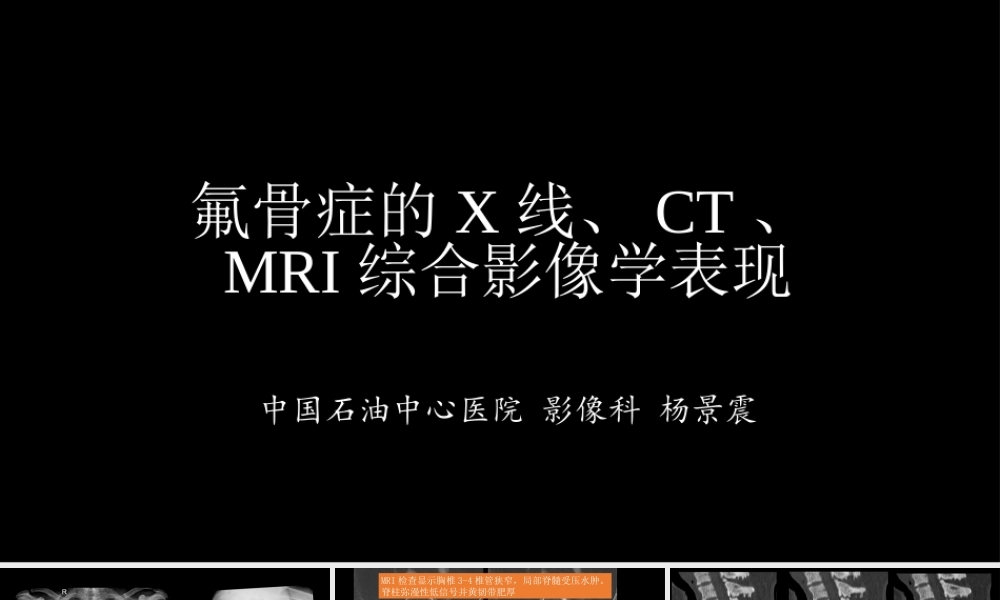 氟骨症的X线CT及MR影像及解读(1).pptx