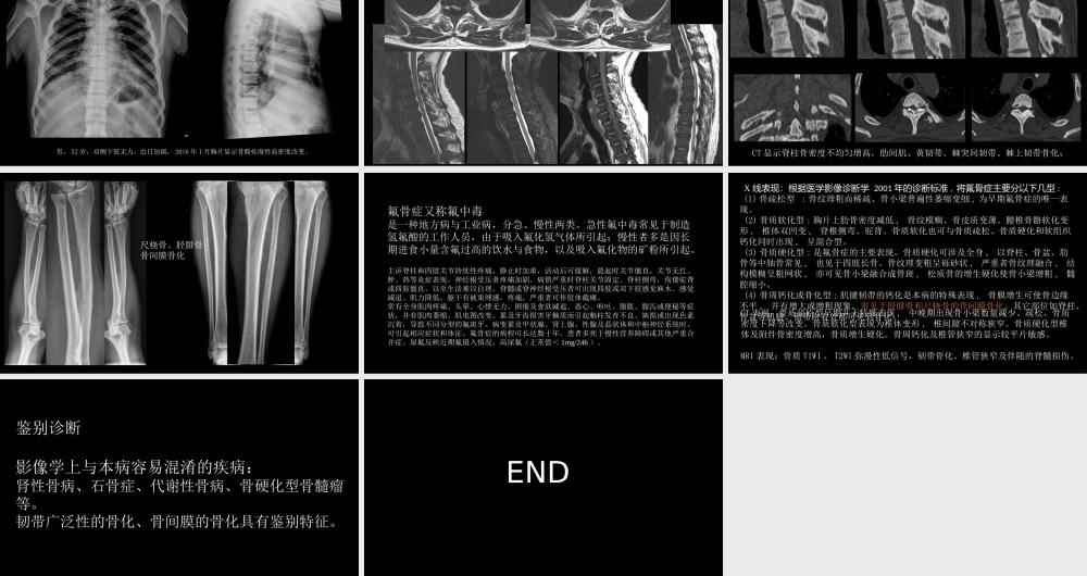 氟骨症的X线CT及MR影像及解读(1).pptx