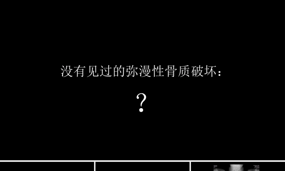 没有见过的弥漫性的骨质破坏(1).pptx
