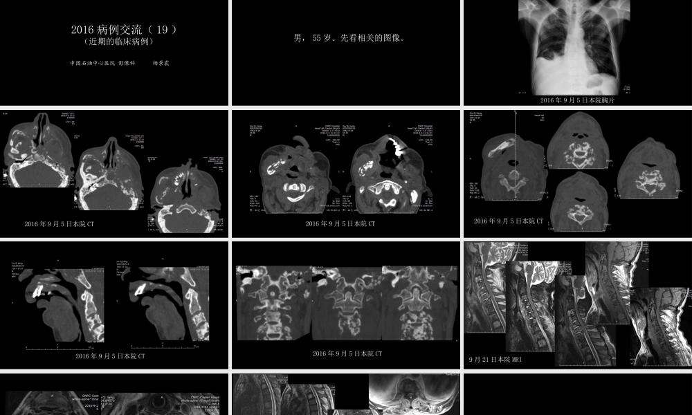 没有见过的弥漫性的骨质破坏(1).pptx