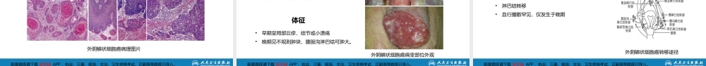 第二十四章 外阴肿瘤.(1).pptx