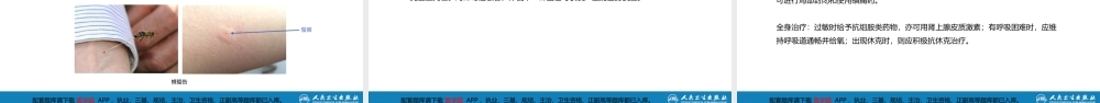 第十三章 烧伤、冻伤、蛇咬伤、犬咬伤、虫蛰伤 第四、五、六节(1).pptx