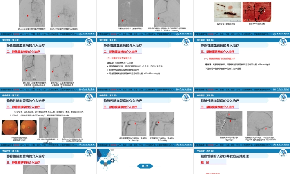 第十章 脑血管病的介入诊疗（3）(1).pptx
