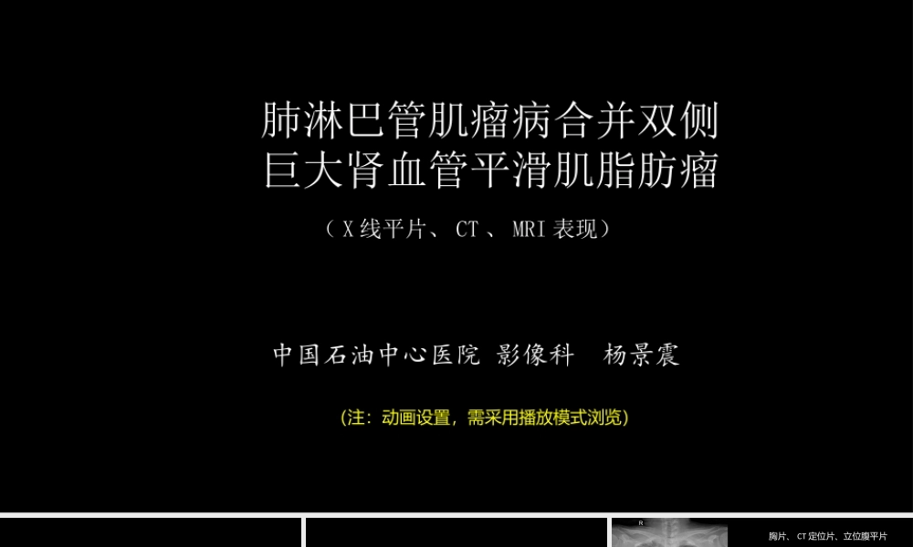 肺淋巴管肌瘤病合并双侧巨大肾血管平滑肌脂肪瘤(X线、CT、MR)(1).pptx
