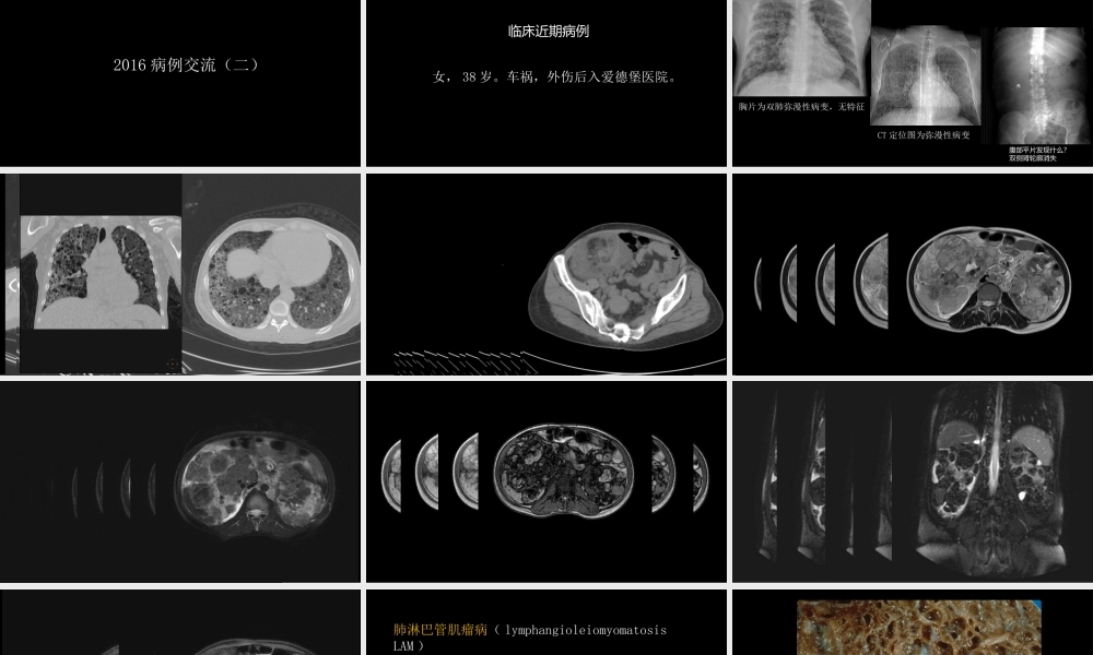 肺淋巴管肌瘤病合并双侧巨大肾血管平滑肌脂肪瘤(X线、CT、MR)(1).pptx