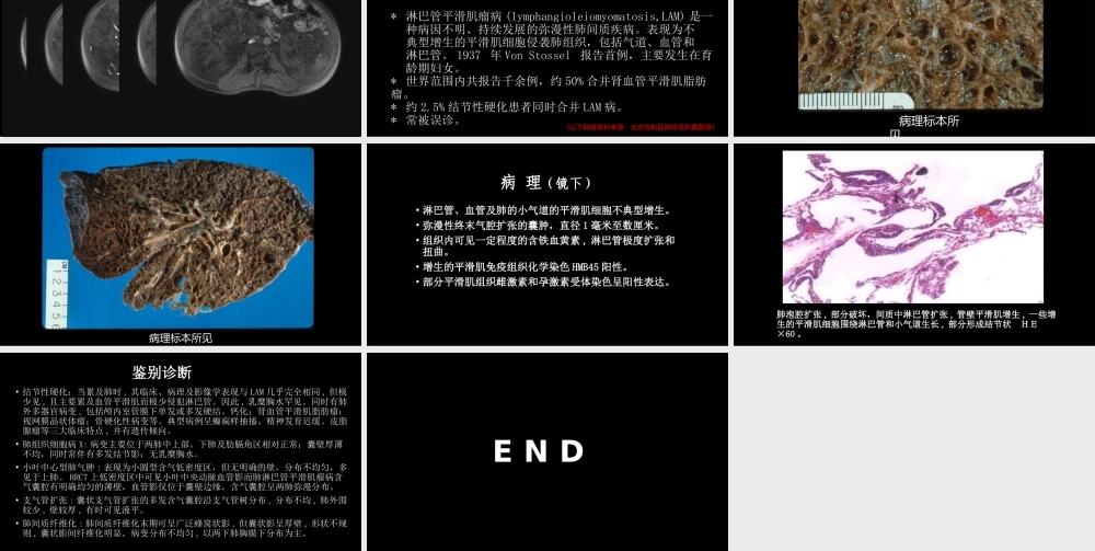 肺淋巴管肌瘤病合并双侧巨大肾血管平滑肌脂肪瘤(X线、CT、MR)(1).pptx