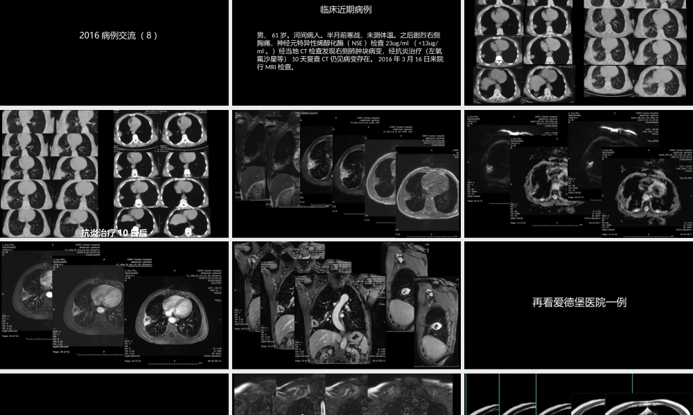 肺部肿块有效的影像检查选择(1).pptx