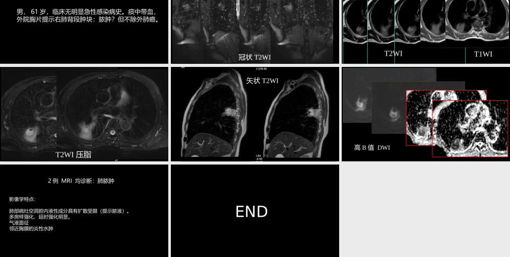 肺部肿块有效的影像检查选择(1).pptx