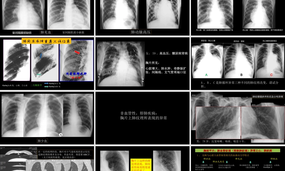 肺血管及肺网状结构影像学与心肺疾病-修改版(1).ppt