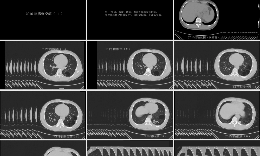 这样的肺隔离症：影像共享(1).pptx