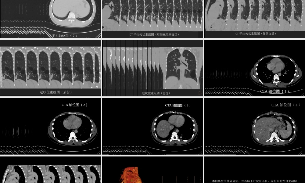 这样的肺隔离症：影像共享(1).pptx