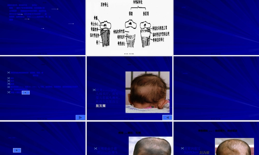 2022年医学专题—佝偻病修改稿教学.ppt