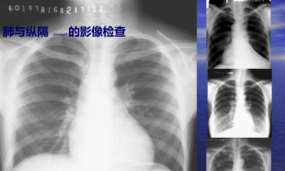 2022年医学专题—教你如何看肺部CT.ppt