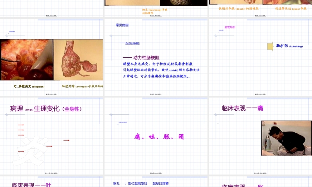 2022年医学专题—肠梗阻ppt.ppt