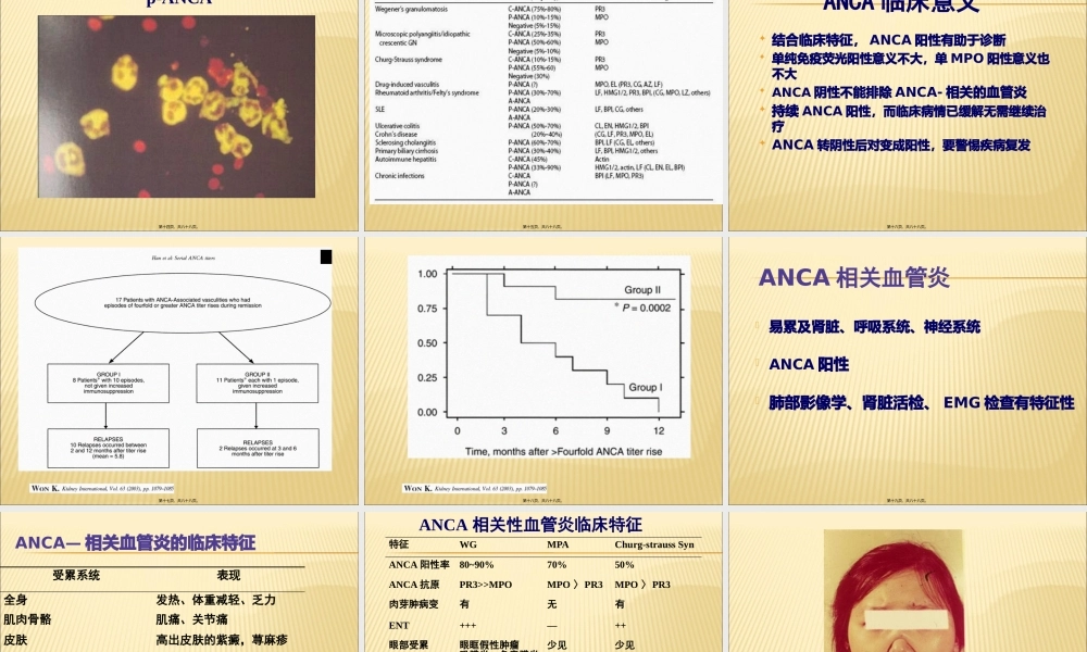 ANCA相关性血管炎诊治.pptx
