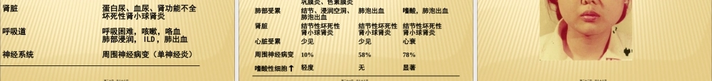 ANCA相关性血管炎诊治.pptx