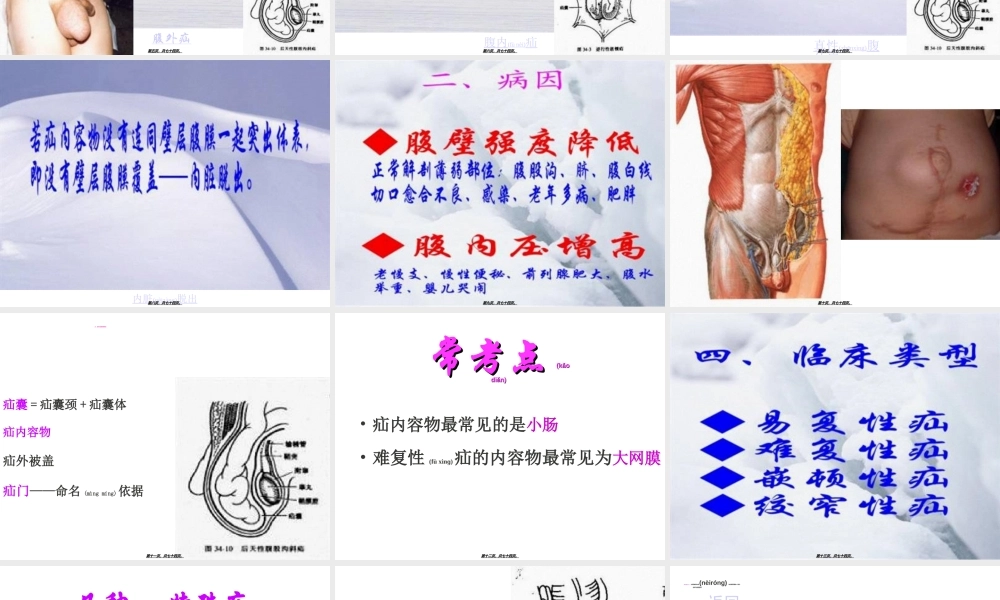 2022年医学专题—腹外疝汇总.ppt