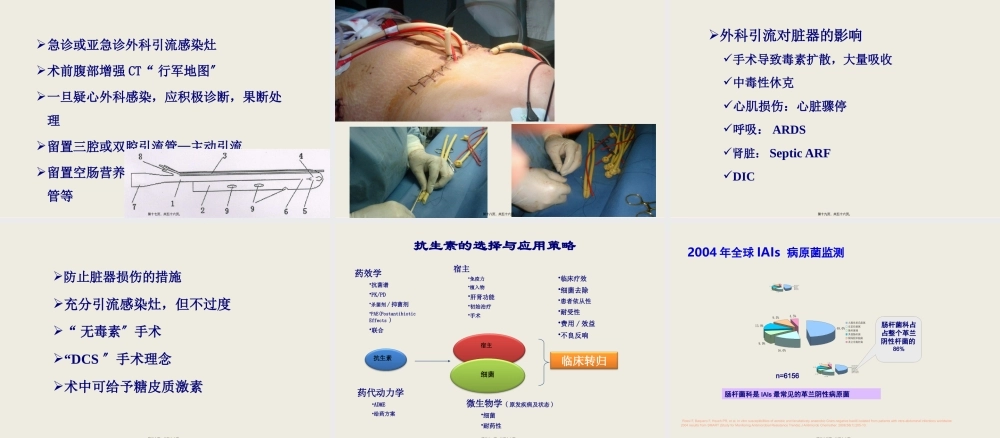 4.复杂性腹腔感染的处理-毛恩强.pptx