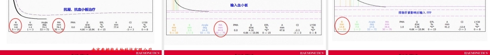 TEG血栓弹力图.pptx