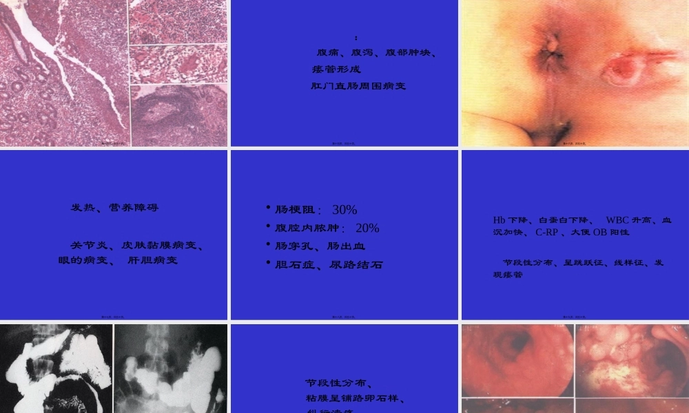 IBD讲稿-炎症性肠病.pptx