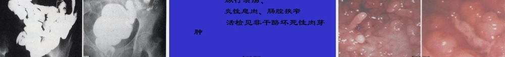 IBD讲稿-炎症性肠病.pptx
