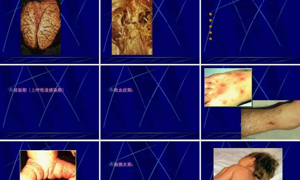 9临-流行性脑脊髓膜炎.pptx