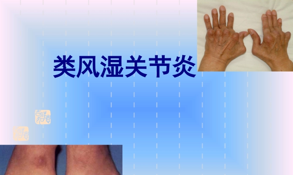 中西结合7年制教材(大量图片)类风湿性关节炎.pptx