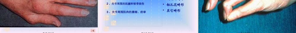 中西结合7年制教材(大量图片)类风湿性关节炎.pptx