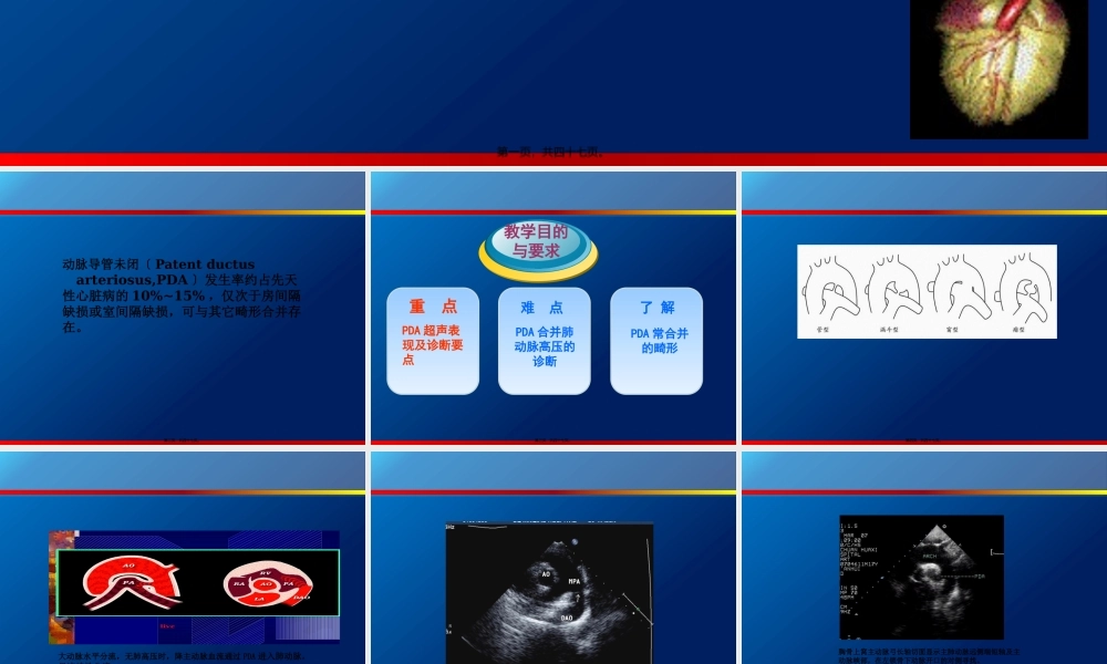 动脉导管未闭、主动脉狭窄超声.pptx