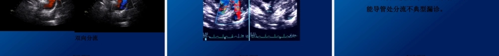 动脉导管未闭、主动脉狭窄超声.pptx