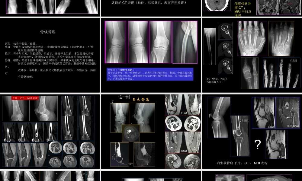 骨肿瘤影像学诊断(1).ppt