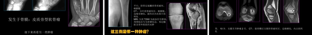 骨肿瘤影像学诊断(1).ppt