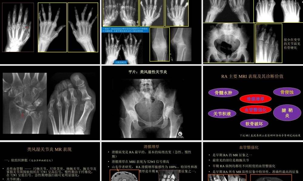 类风湿性、强直性脊柱炎的影像学诊断(1).ppt