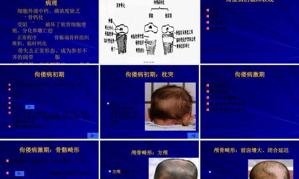佝偻病修改稿教学.pptx