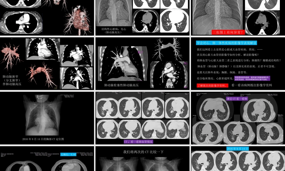 胸部影像解读：心肺一体性疾病(1).pptx