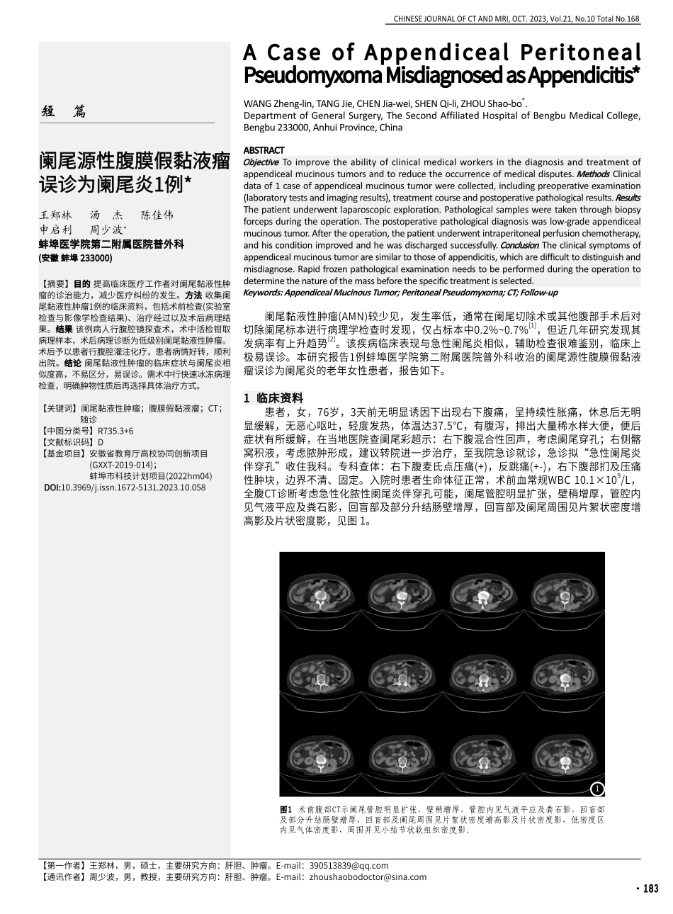 阑尾源性腹膜假黏液瘤误诊为阑尾炎1例.pdf_第1页